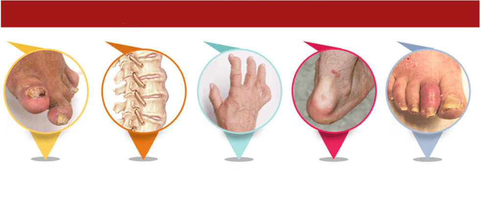 typy psoriatické artritidy